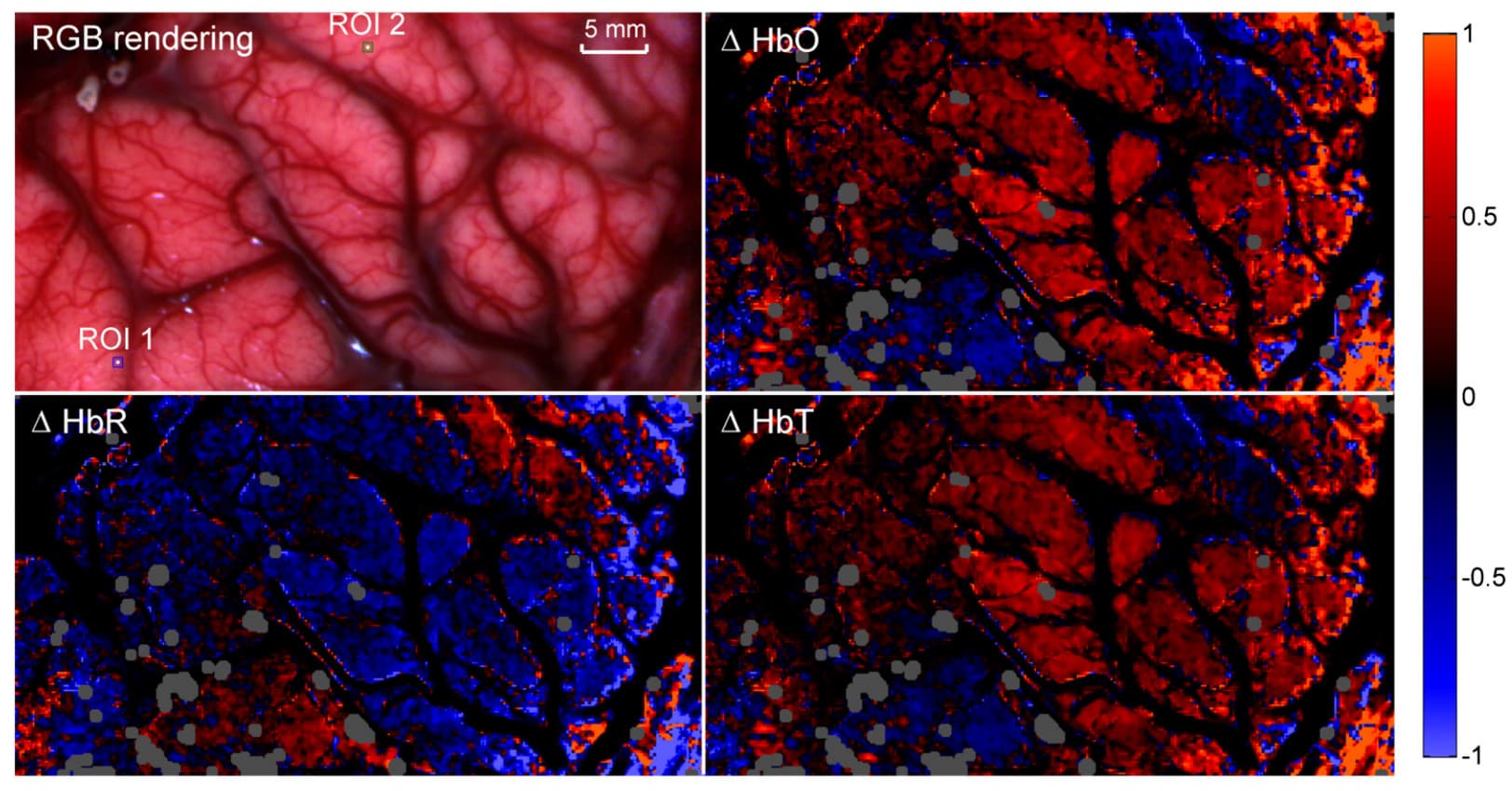 snapshot hyperspectral imaging oxygenation map brain surgery