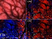 Hyperspectral imaging of brain oxygenation under epilepsy surgery